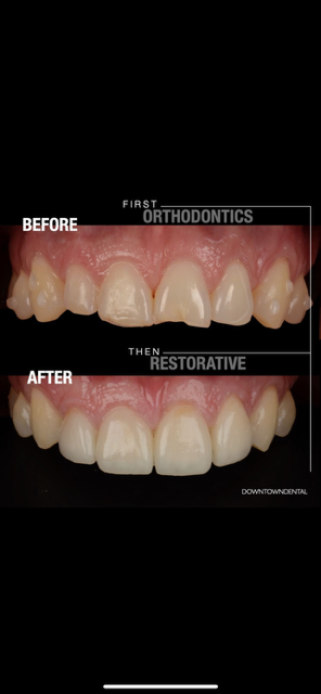 Porcelain Laminate B&A